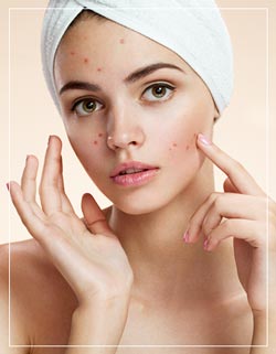 Acne Treatments Near Me in Los Altos, CA