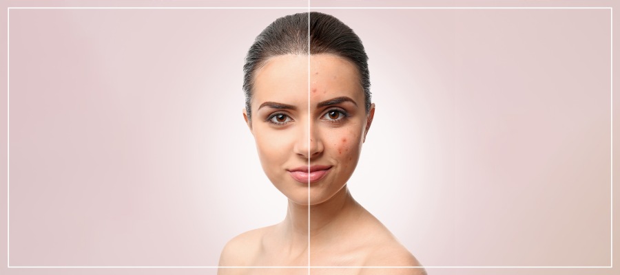 Acne Facial Treatment Specialist Near Me in Los Altos, CA Acne Facial Treatment Specialist Near Me in Los Altos, CA