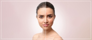 Acne Facial Treatment Specialist Near Me in Los Altos, CA Acne Facial Treatment Specialist Near Me in Los Altos, CA