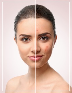 Acne Facial Near Me in Los Altos, CA