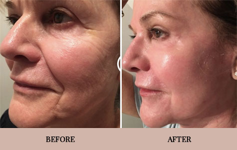 Laser Skin Resurfacing in Los Altos, CA