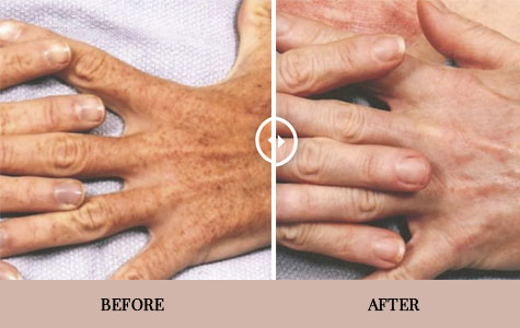 Laser Skin Resurfacing in Los Altos, CA