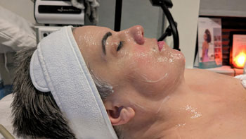 FORMA Treatment Before and After Photos of ABC Health and Beauty in Los Altos, CA